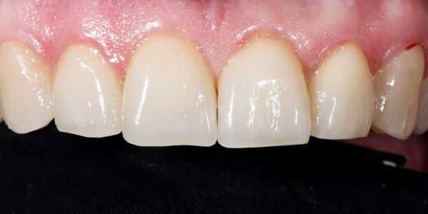 Veneers